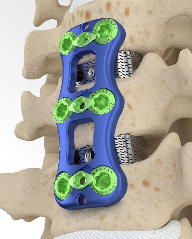 Atec Insignia Anterior cervical plating system ACDF